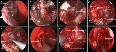 Endoscopic endonasal resection of two rare cases of hemangiopericytomas invading the cavernous sinus and literature review
